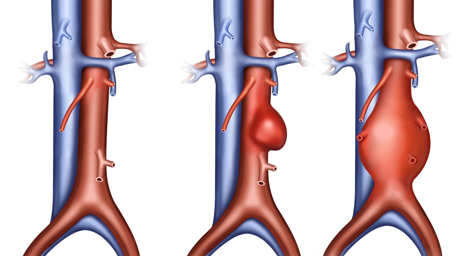 Disectia de aorta poate sa fie vindecata cu tratament medicamentos sau in varianta chirurgicala